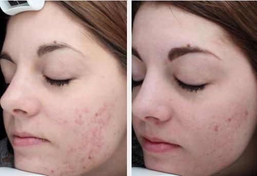 Front 4 treatments acne BBL-results in 2 months 