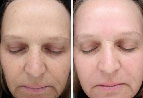Front Halo laser to reduce fine lines and sundamage and improve skin texture