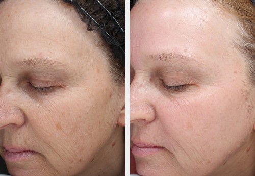 Side Halo laser to reduce fine lines and sundamage and improve skin texture 